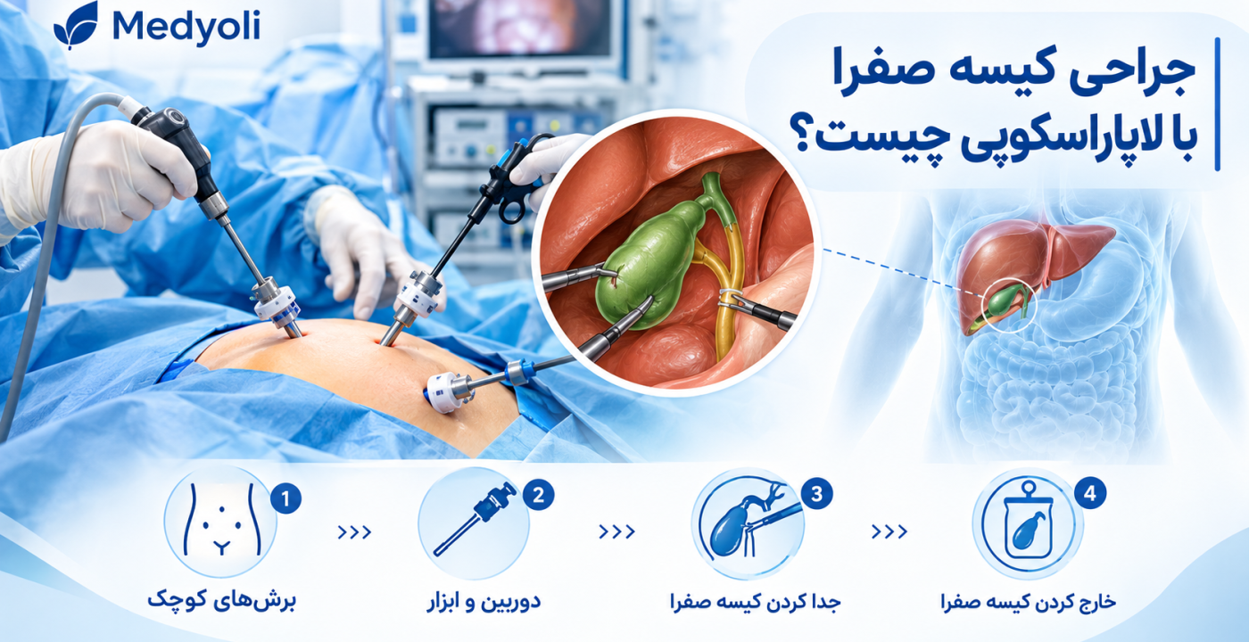 جراحی کیسه صفرا با لاپاروسکوپی چیست؟ مراحل عمل، مزایا، عوارض و دوران نقاهت