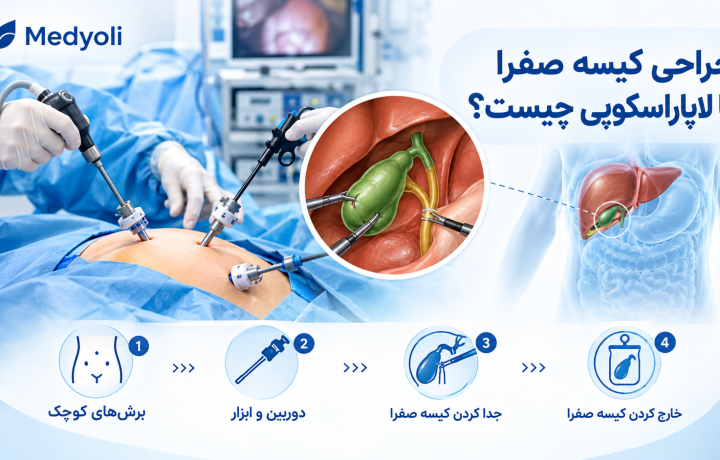 جراحی کیسه صفرا با لاپاروسکوپی چیست؟ مراحل عمل، مزایا، عوارض و دوران نقاهت