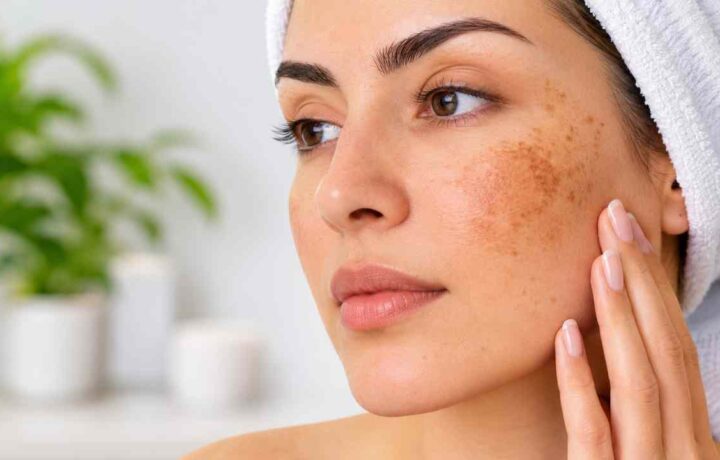 لک صورت از چیست؟ علت‌ها، انواع لک، روش‌های درمان و پیشگیری