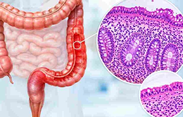 بیماری التهابی روده چیست؟ علائم کرون، کولیت اولسراتیو و کولیت میکروسکوپی خ