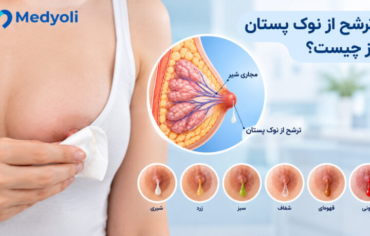 ترشح از نوک پستان از چیست؟ علت، رنگ ترشحات و زمان مراجعه به پزشک
